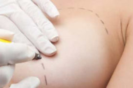 Chirurgie des seins
