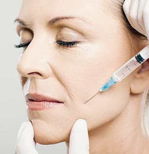 Comblement des sillons naso géniens par injection d'acide hyaluronique. Comblement des sillons naso géniens par injection d'acide hyaluronique.