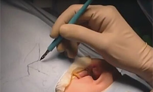 Chirurgie reconstructrice : fente labio-palatine