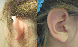 Chirurgie reconstructrice : otoplastie