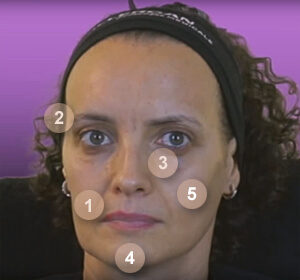 Injections Juvéderm sur le visage Injections Juvéderm sur le visage
