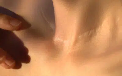Faire disparaître une cicatrice : 6 techniques - Dr Laurence Benouaiche | Paris