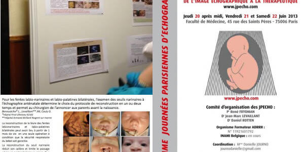 Poster Jpecho 2013 : Échographie et fente labio-palatine