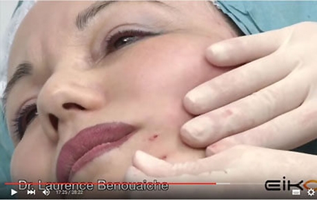 Vidéo : séance de pose de fils tenseurs Silhouette Soft - Dr Benouaiche - Paris