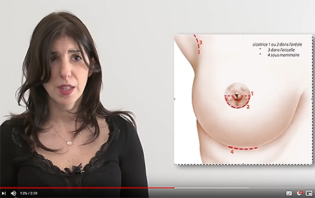 Vidéo : prothèses et implants mammaires - Dr Benouaiche - Paris