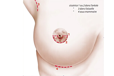 Cicatrices et prothèses mammaires