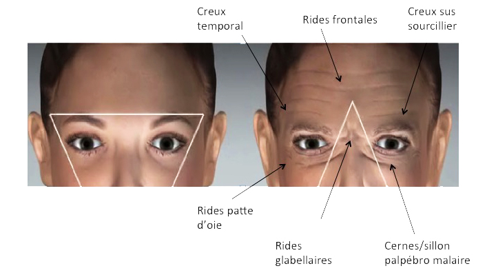 Zone du regard : les interventions en médecine esthétique