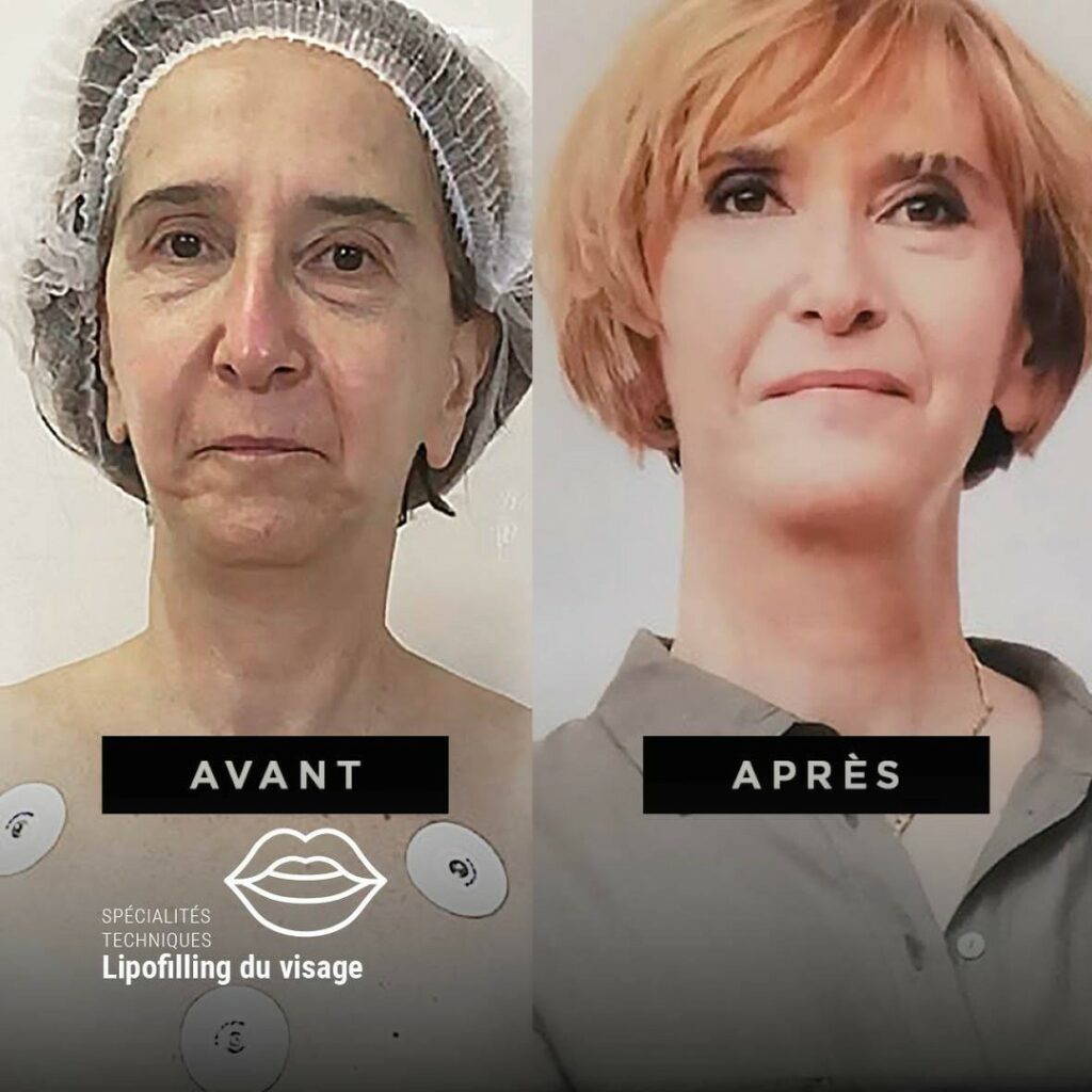 Avant/Après : Lipofilling du visage - Dr Benouaiche - Paris