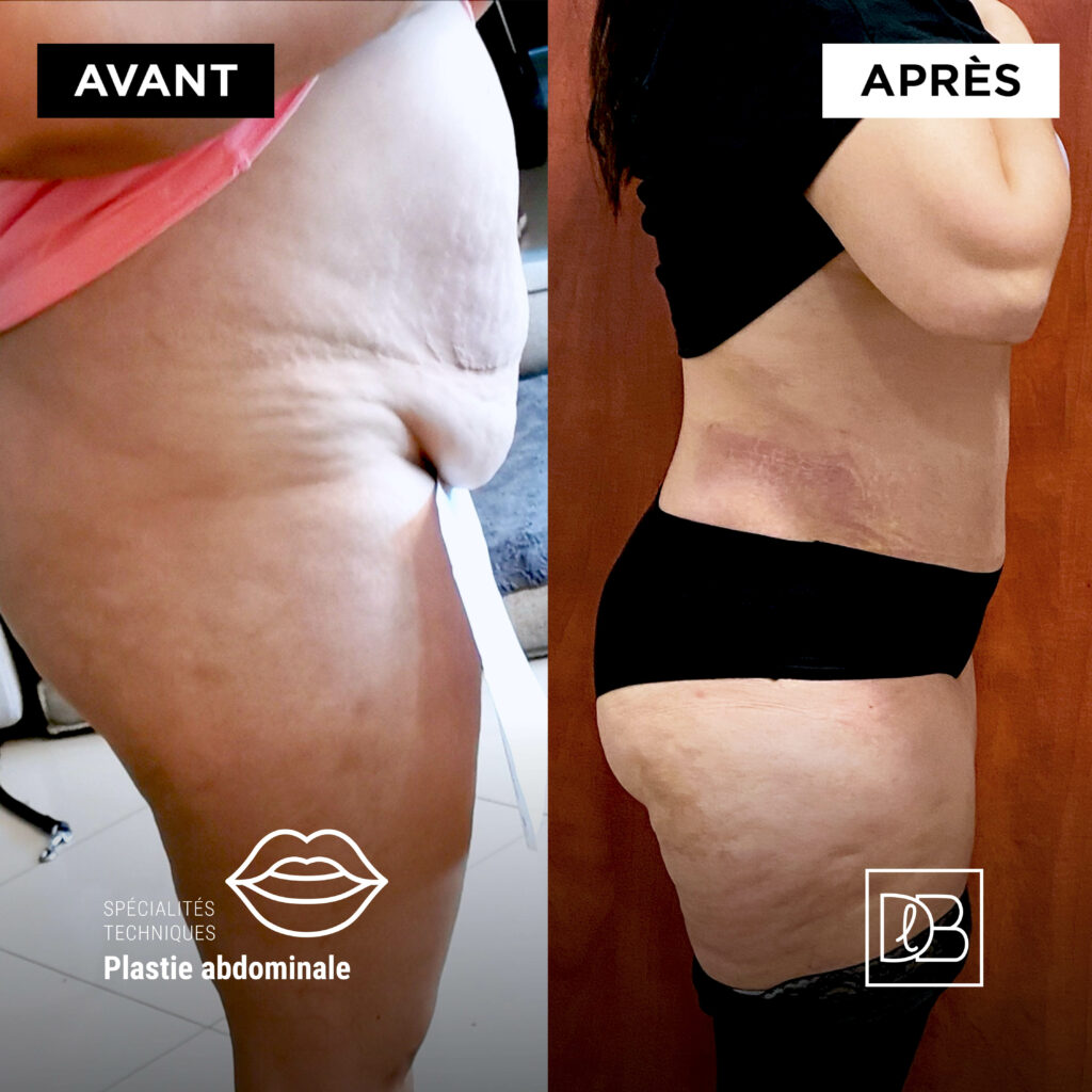 Avant/Après : Plastie abdominale - Dr Benouaiche - Paris