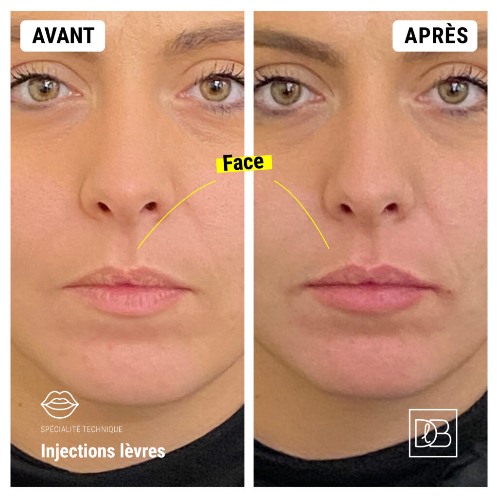 Injections d'acide hyaluronique : Lèvres Avant/Après de face