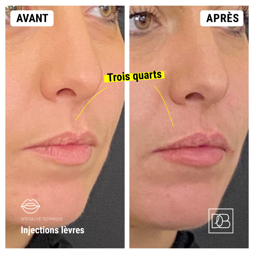Injections d'acide hyaluronique : Lèvres Avant/Après de trois quarts face