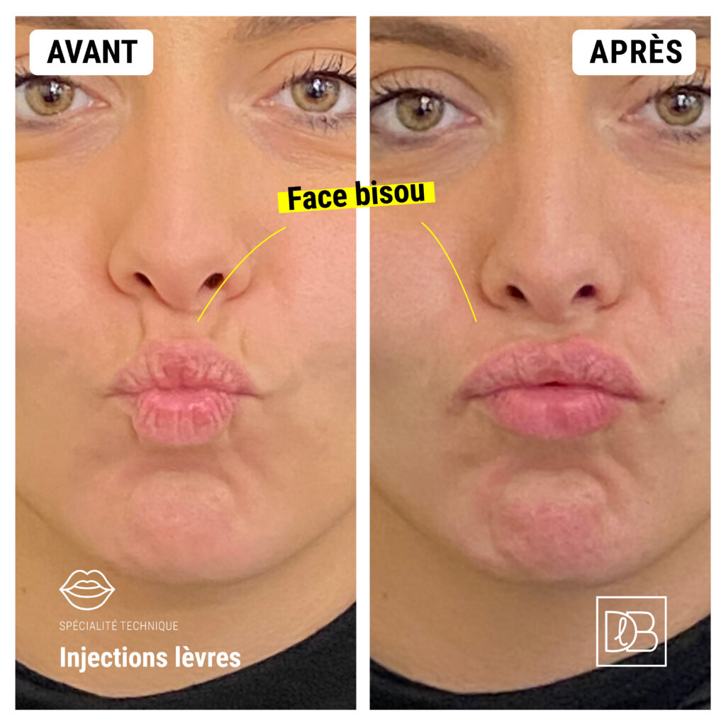 Injections d'acide hyaluronique : Lèvres Avant/Après de face bisou