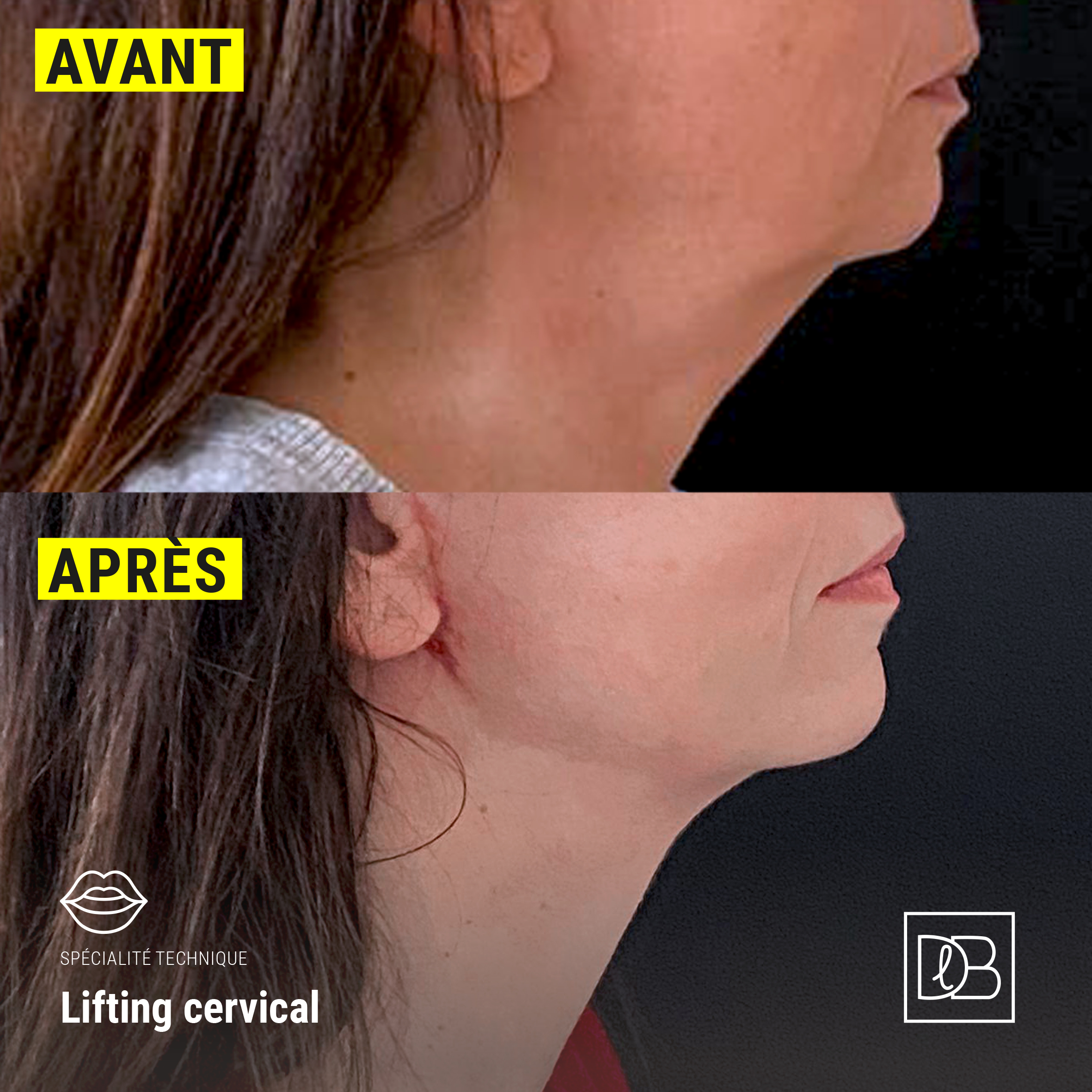 Avant / Après : lifting cervico-facial - Docteur Benouaiche, Paris