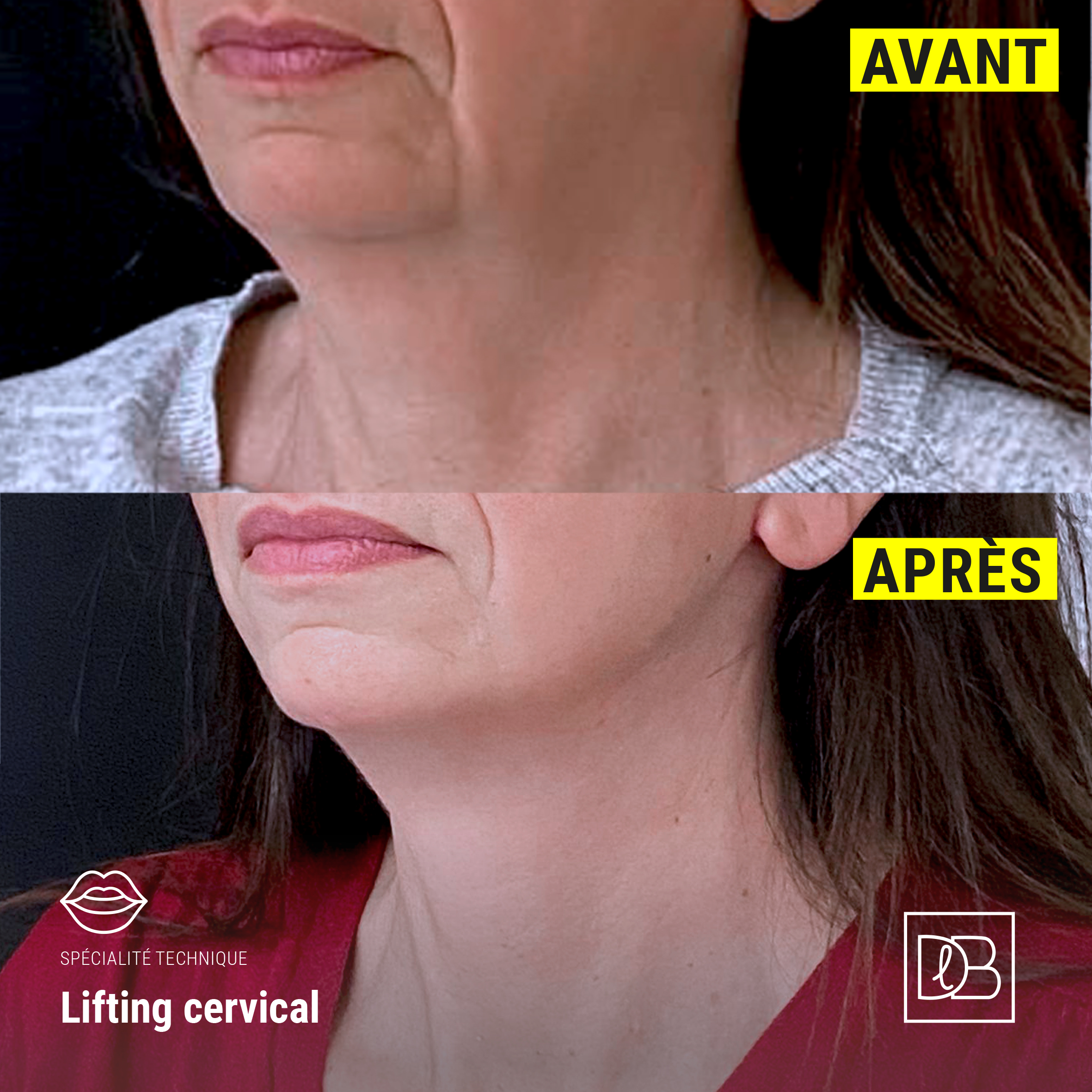 Avant / Après : lifting cou et visage - Docteur Benouaiche, Paris