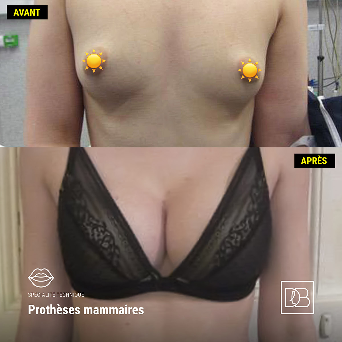 Avant Après un implant de prothèses mammaires (Dr Benouaiche, Paris)