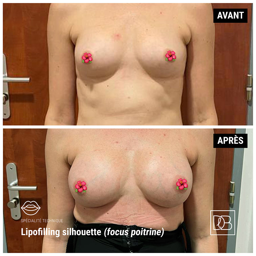 Lipofilling des seins - avant après de face