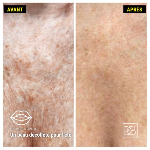 Skinbooster : un beau décolleté pour l'été (avant après)