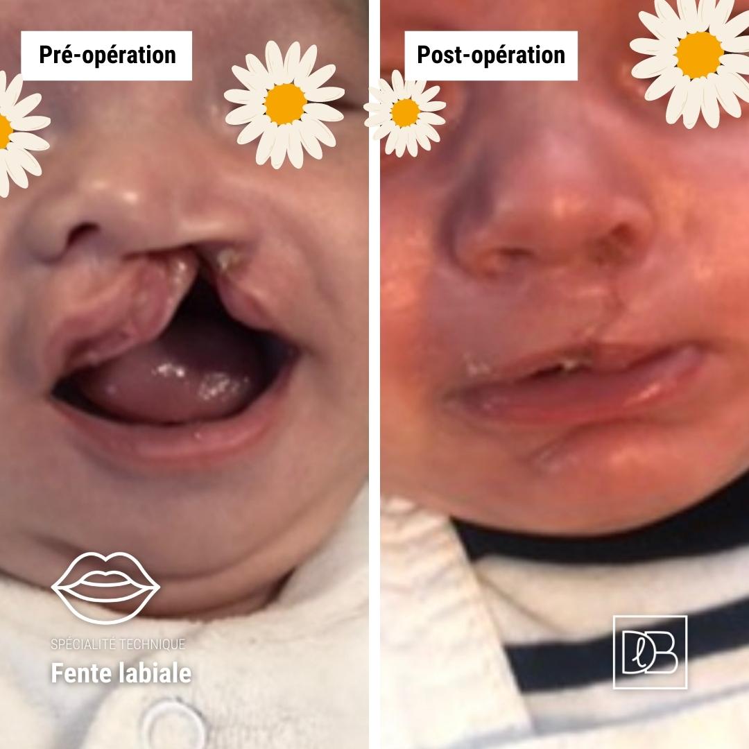 Fente labiale chez une bébé : avant / après une opération